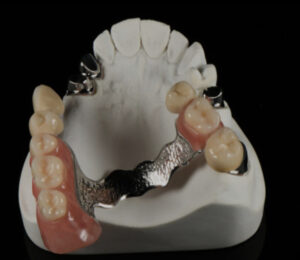 Metal framework-Mapledent Lab